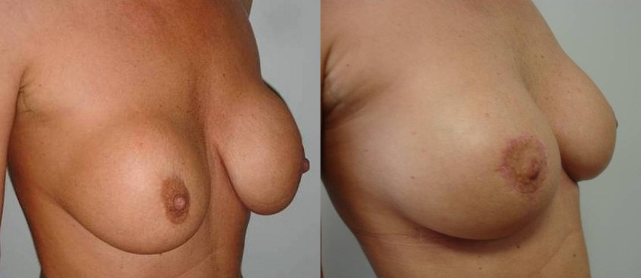 Lifting del seno – 6 mesi dopo